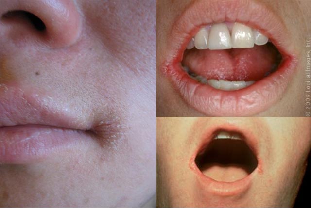Pictures of adults with angular cheilitis