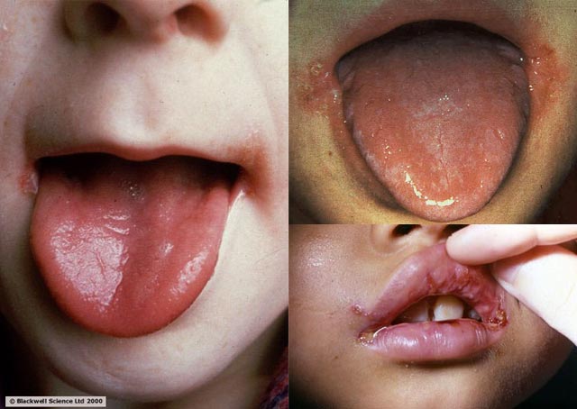 Pictures of Children with Angular Cheilitis