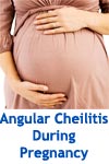 Angular Cheilitis During Pregnancy