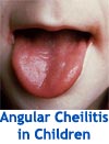 Angular Cheilitis in Children