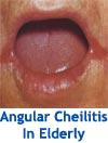 Angular Cheilitis In Elderly