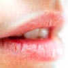 Angular Cheilitis Lips