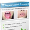 Angular Cheilitis Treatment