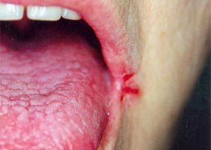 Dry, Cracked Corners of the Mouth | LIVESTRONG.COM