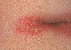facial herpes symptoms #10