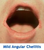 Mild Angular Cheilitis