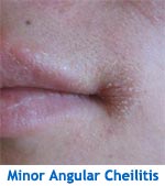 Minor Angular Cheilitis