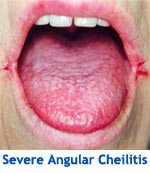 Severe Angular Cheilitis