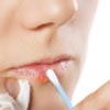 Mouth Illnesses Similar to Angular Cheilitis